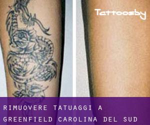 Rimuovere Tatuaggi a Greenfield (Carolina del Sud)