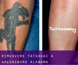Rimuovere Tatuaggi a Greensboro (Alabama)