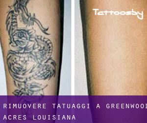 Rimuovere Tatuaggi a Greenwood Acres (Louisiana)