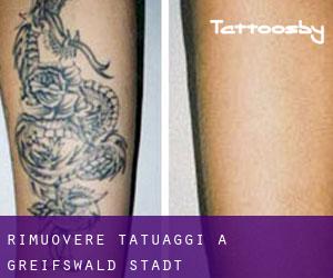 Rimuovere Tatuaggi a Greifswald Stadt
