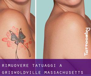 Rimuovere Tatuaggi a Griswoldville (Massachusetts)