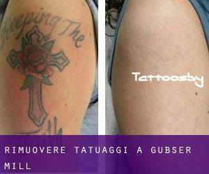 Rimuovere Tatuaggi a Gubser Mill