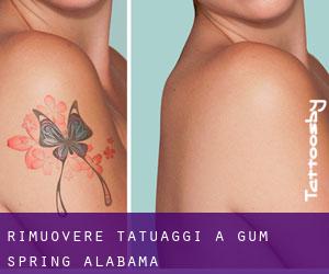 Rimuovere Tatuaggi a Gum Spring (Alabama)