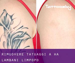 Rimuovere Tatuaggi a Ha-Lambani (Limpopo)