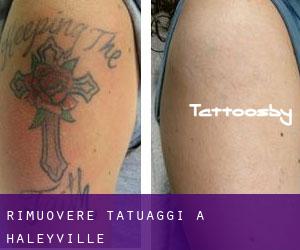 Rimuovere Tatuaggi a Haleyville