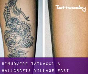 Rimuovere Tatuaggi a Hallcrafts Village East