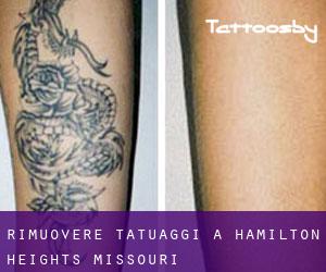 Rimuovere Tatuaggi a Hamilton Heights (Missouri)