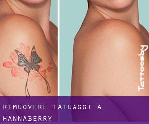 Rimuovere Tatuaggi a Hannaberry