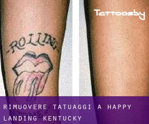 Rimuovere Tatuaggi a Happy Landing (Kentucky)