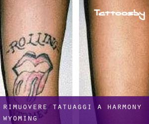 Rimuovere Tatuaggi a Harmony (Wyoming)