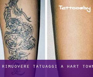 Rimuovere Tatuaggi a Hart Town