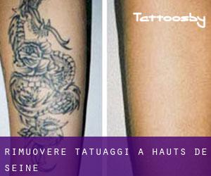 Rimuovere Tatuaggi a Hauts-de-Seine