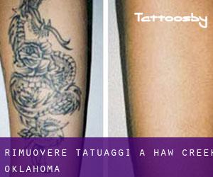 Rimuovere Tatuaggi a Haw Creek (Oklahoma)