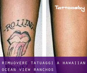 Rimuovere Tatuaggi a Hawaiian Ocean View Ranchos