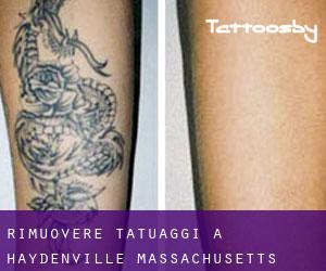 Rimuovere Tatuaggi a Haydenville (Massachusetts)
