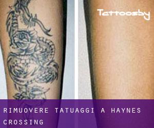 Rimuovere Tatuaggi a Haynes Crossing