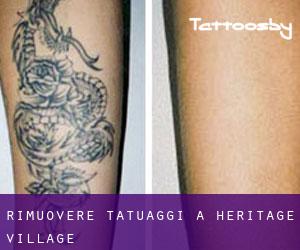 Rimuovere Tatuaggi a Heritage Village