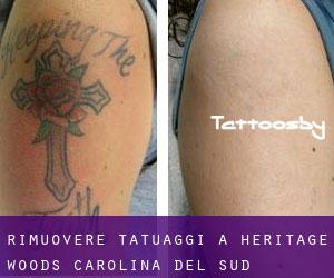 Rimuovere Tatuaggi a Heritage Woods (Carolina del Sud)