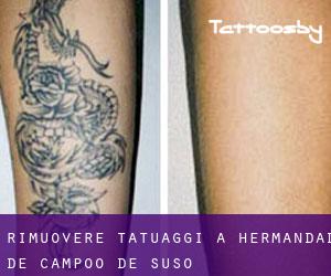 Rimuovere Tatuaggi a Hermandad de Campoo de Suso