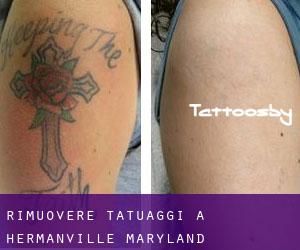 Rimuovere Tatuaggi a Hermanville (Maryland)