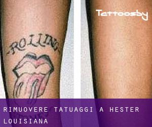 Rimuovere Tatuaggi a Hester (Louisiana)