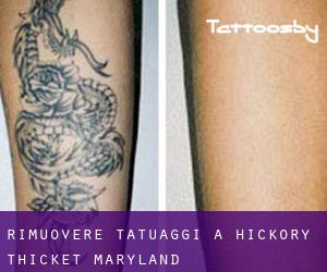 Rimuovere Tatuaggi a Hickory Thicket (Maryland)