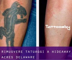 Rimuovere Tatuaggi a Hideaway Acres (Delaware)