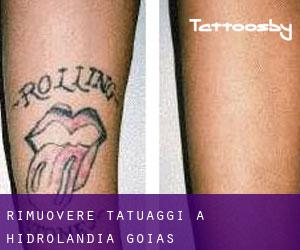 Rimuovere Tatuaggi a Hidrolândia (Goiás)