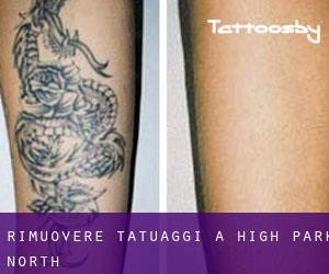 Rimuovere Tatuaggi a High Park North