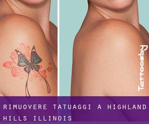 Rimuovere Tatuaggi a Highland Hills (Illinois)
