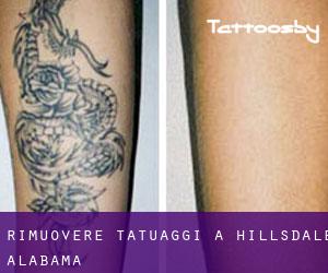 Rimuovere Tatuaggi a Hillsdale (Alabama)