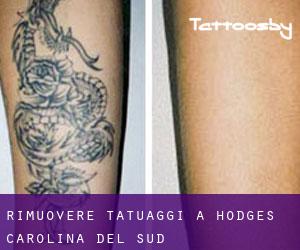 Rimuovere Tatuaggi a Hodges (Carolina del Sud)