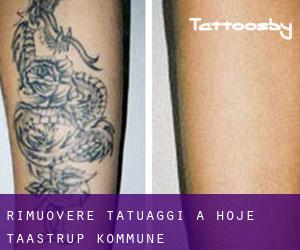 Rimuovere Tatuaggi a Høje-Taastrup Kommune