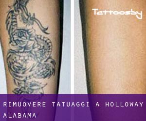 Rimuovere Tatuaggi a Holloway (Alabama)