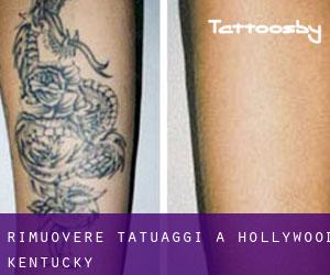 Rimuovere Tatuaggi a Hollywood (Kentucky)