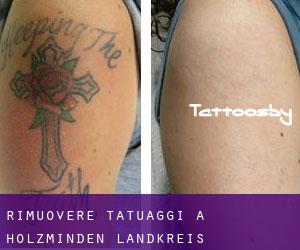 Rimuovere Tatuaggi a Holzminden Landkreis
