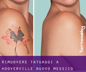 Rimuovere Tatuaggi a Hooverville (Nuovo Messico)