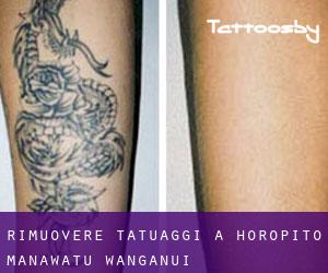 Rimuovere Tatuaggi a Horopito (Manawatu-Wanganui)