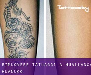 Rimuovere Tatuaggi a Huallanca (Huanuco)