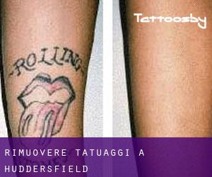 Rimuovere Tatuaggi a Huddersfield