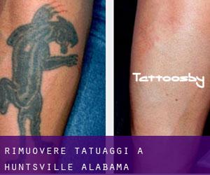 Rimuovere Tatuaggi a Huntsville (Alabama)