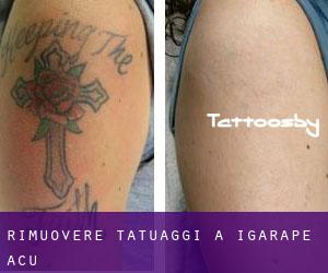 Rimuovere Tatuaggi a Igarapé-Açu