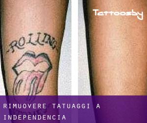 Rimuovere Tatuaggi a Independencia