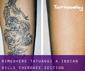 Rimuovere Tatuaggi a Indian Hills Cherokee Section