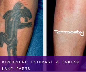 Rimuovere Tatuaggi a Indian Lake Farms