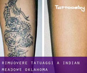 Rimuovere Tatuaggi a Indian Meadows (Oklahoma)