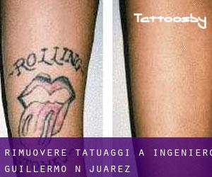 Rimuovere Tatuaggi a Ingeniero Guillermo N. Juárez