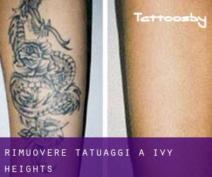Rimuovere Tatuaggi a Ivy Heights