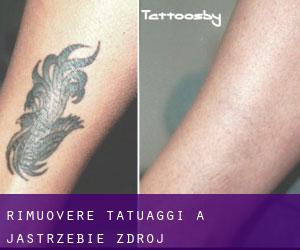 Rimuovere Tatuaggi a Jastrzębie-Zdrój