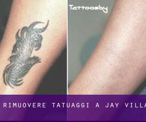 Rimuovere Tatuaggi a Jay Villa